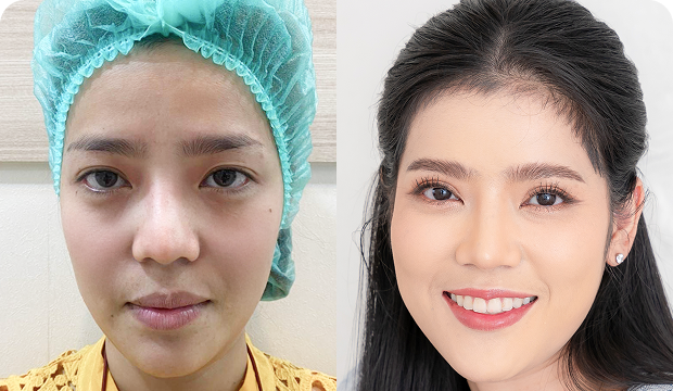 คุณทราย ศัลยกรรมตาสองชั้น ร่วมกับการตัดหนังตาและเปิดหัวตา