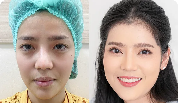 คุณทราย ศัลยกรรมตาสองชั้น ร่วมกับการตัดหนังตาและเปิดหัวตา