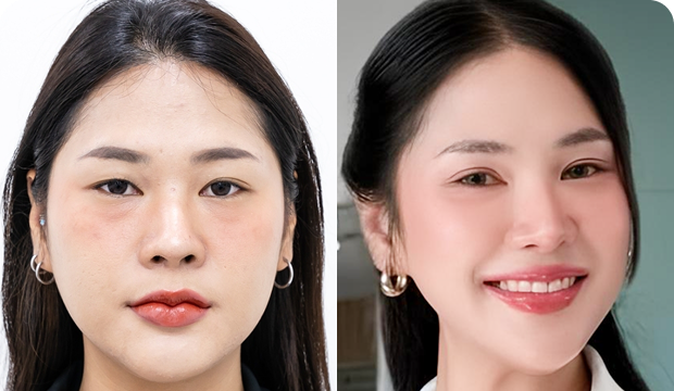 คุณเปรี้ยว ศัลยกรรมตาสองชั้น ร่วมกับตัดหนังตา เปิดหัวตา และแก้ไขกล้ามเนื้อตาอ่อนแรง