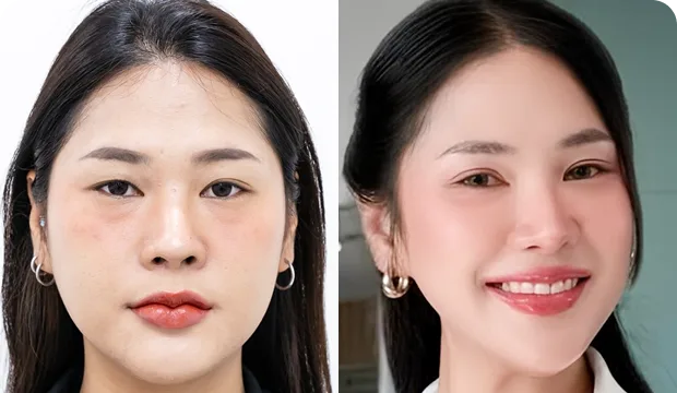 คุณเปรี้ยว ศัลยกรรมตาสองชั้น ร่วมกับตัดหนังตา เปิดหัวตา และแก้ไขกล้ามเนื้อตาอ่อนแรง